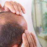 Hair loss may be a coronavirus symptom, study finds
