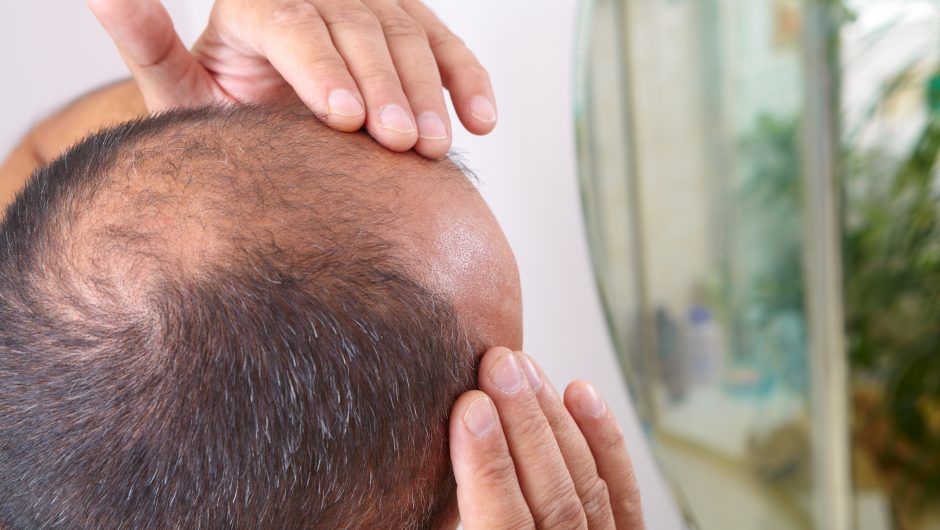Hair loss may be a coronavirus symptom, study finds