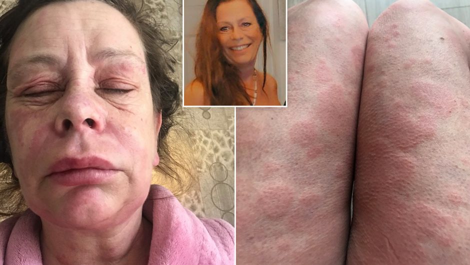 UK woman says COVID-19 vaccine turned her into ‘Alien’ monster