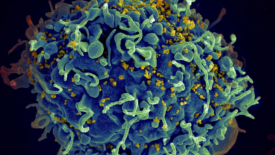 UN urges action to end AIDS, saying COVID-19 hurt progress