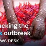 How dangerous is the mpox clade Ib public health emergency? | News Desk
